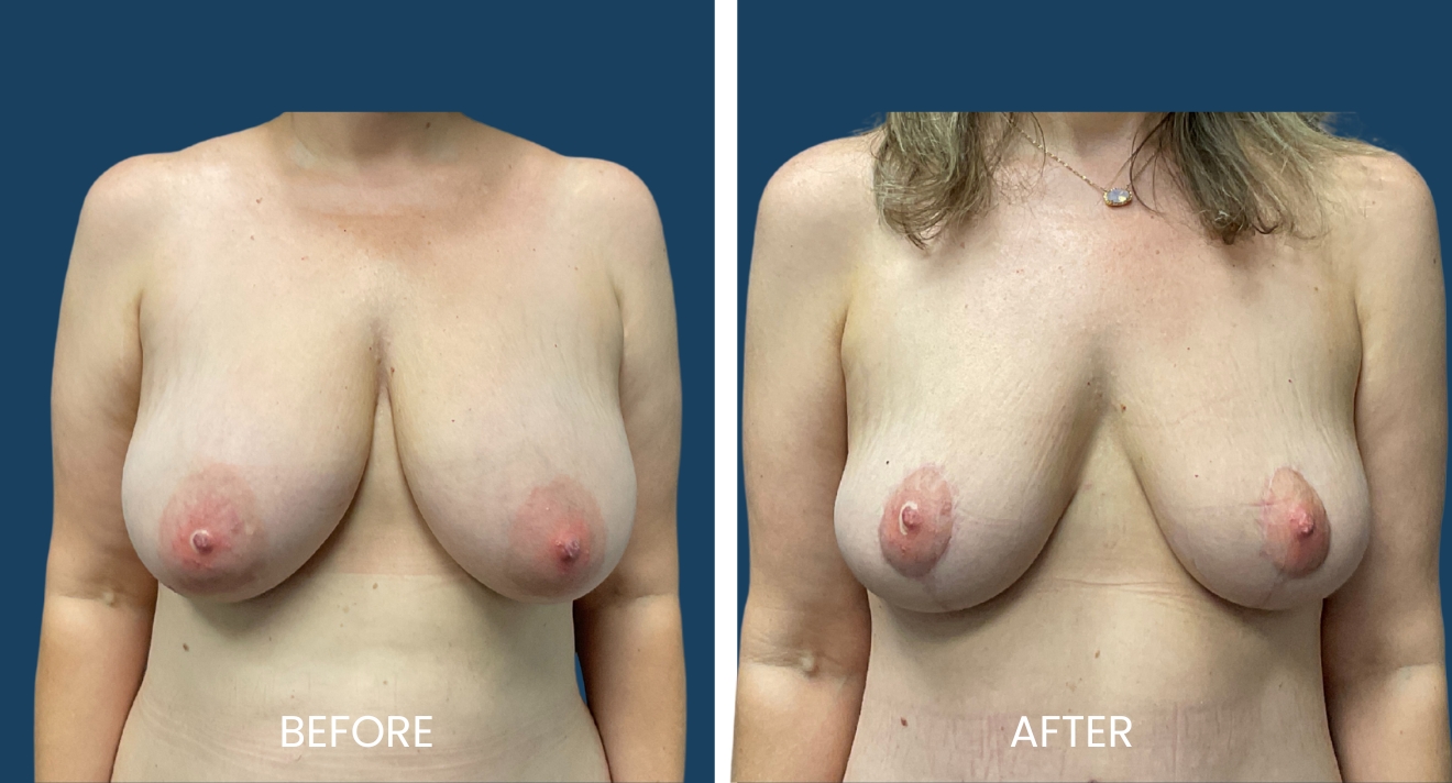 Before and after images showcasing breast reduction results. The left side displays the "before" photo, highlighting the original breast size and shape. The right side presents the "after" photo, illustrating the reduced breast volume and improved contour. This visual comparison emphasizes the transformation achieved through the procedure, offering insights into the aesthetic benefits of breast reduction surgery. Ideal for individuals considering this procedure, the images serve as a reference for potential outcomes and enhancements in body confidence.