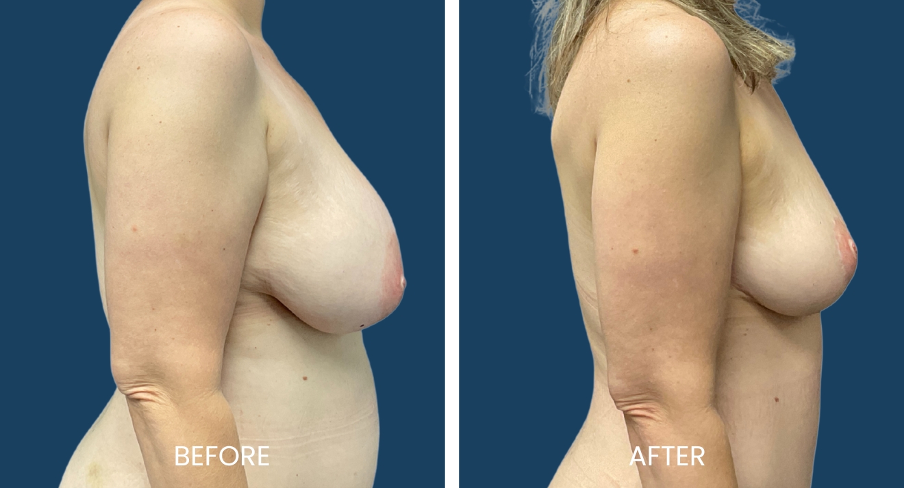 Before and after images showcasing a side profile of a woman's torso, highlighting changes in breast appearance and body contouring. The left image labeled "Before" displays a fuller breast shape, while the right image labeled "After" shows a lifted and firmer breast contour. The background is a solid blue, emphasizing the subject's transformation. These images illustrate the results of cosmetic procedures aimed at enhancing body aesthetics and boosting confidence. Ideal for individuals considering similar treatments or seeking visual comparisons for body enhancement options.