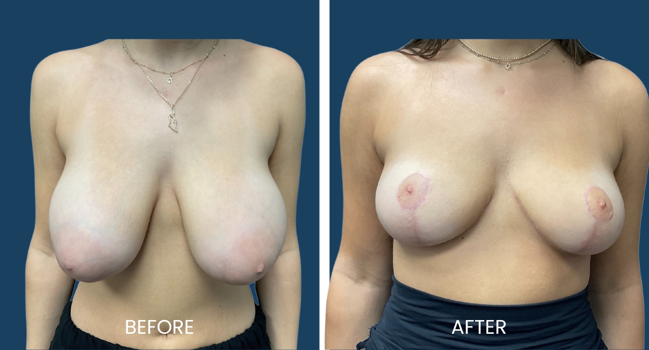 Before and after images showcasing breast reduction surgery results. The left side displays the patient's breasts prior to the procedure, highlighting a fuller appearance. The right side shows the post-surgery results, featuring a more balanced and contoured breast shape with visible healing. Both images emphasize the transformation achieved through the surgical process. The background is a solid navy blue, enhancing the focus on the patient’s chest area. These images serve to inform potential patients about the aesthetic outcomes of breast reduction surgery.
