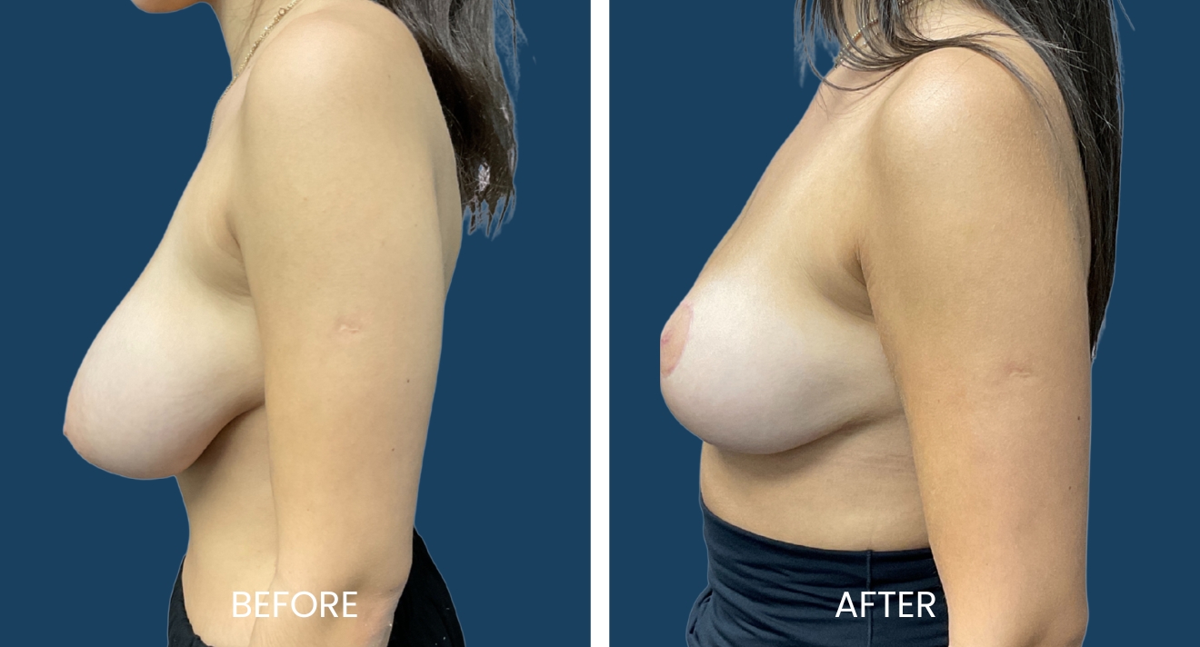 Image showing a side-by-side comparison of a woman's breast appearance before and after a cosmetic procedure. The left side labeled "Before" displays a less contoured shape, while the right side labeled "After" shows a fuller, enhanced profile. Both images are set against a solid dark blue background, highlighting the changes made. This visual representation aims to inform viewers about the potential results of breast enhancement procedures, showcasing the transformation in a clear and accessible manner.