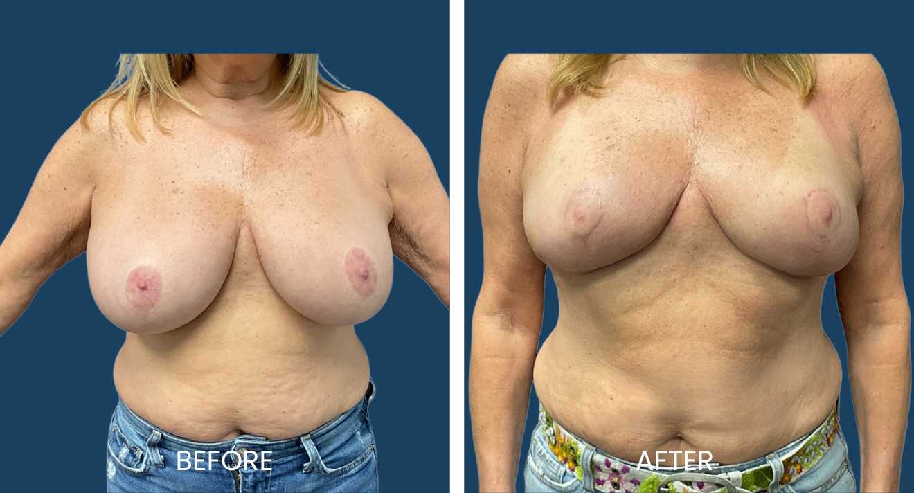 Before and after images showcasing breast enhancement results in a female patient. The left side displays the "before" view, highlighting fuller breasts with visible skin texture. The right side shows the "after" view, revealing a more contoured appearance with improved breast shape and reduced skin irregularities. Both images emphasize the transformation achieved through surgical intervention, aimed at enhancing body confidence and aesthetic appeal. The background is a solid blue, providing a clear contrast to the subject.