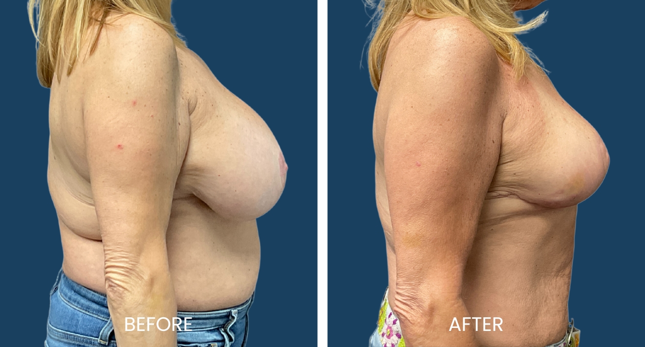 Before and after images of a woman showcasing the results of a breast lift procedure. The left side displays the "before" view, highlighting sagging and volume loss, while the right side presents the "after" view, demonstrating improved breast shape and firmness. Both images are captured from a side angle, emphasizing the transformation and aesthetic enhancement achieved through the surgical procedure. The background is a solid blue, providing contrast to the subject. This visual comparison aims to inform potential patients about the benefits of breast lift surgery