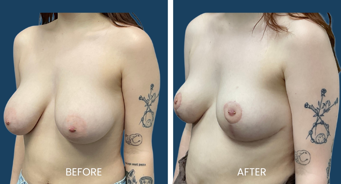 Before and after images showcasing breast augmentation results. The left side displays the "before" appearance, highlighting natural breast shape and size, while the right side presents the "after" look, illustrating enhanced volume and contour. Both images feature a model with visible tattoos and piercings, set against a solid blue background. These images serve to inform potential clients about the transformative effects of breast augmentation procedures, emphasizing the aesthetic improvements achieved through surgical enhancement.