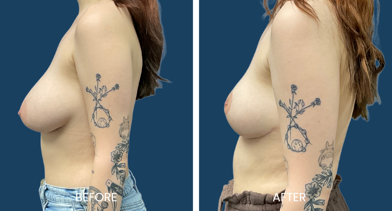 Image showing a side-by-side comparison of a woman's breast appearance before and after a cosmetic procedure. The left side labeled "Before" displays a fuller breast profile, while the right side labeled "After" shows a more enhanced and defined shape. Both images highlight the woman's arm, adorned with tattoos, against a solid blue background. This visual representation aims to illustrate the transformative effects of cosmetic surgery, focusing on aesthetic enhancement and body confidence.