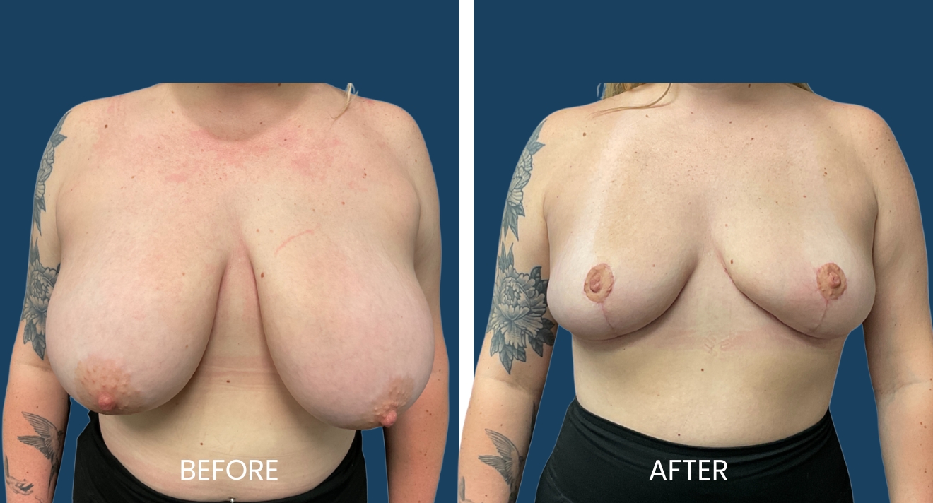 Before and after images of a breast reduction procedure, showcasing significant changes in breast size and shape. The left side displays the patient prior to surgery, highlighting larger breasts with visible skin irritation. The right side illustrates the post-operative results, featuring a smaller, more contoured breast appearance with healed incisions. These images emphasize the transformative effects of breast reduction surgery, aimed at improving physical comfort and aesthetic balance. Ideal for educational purposes related to cosmetic surgery and patient experiences.