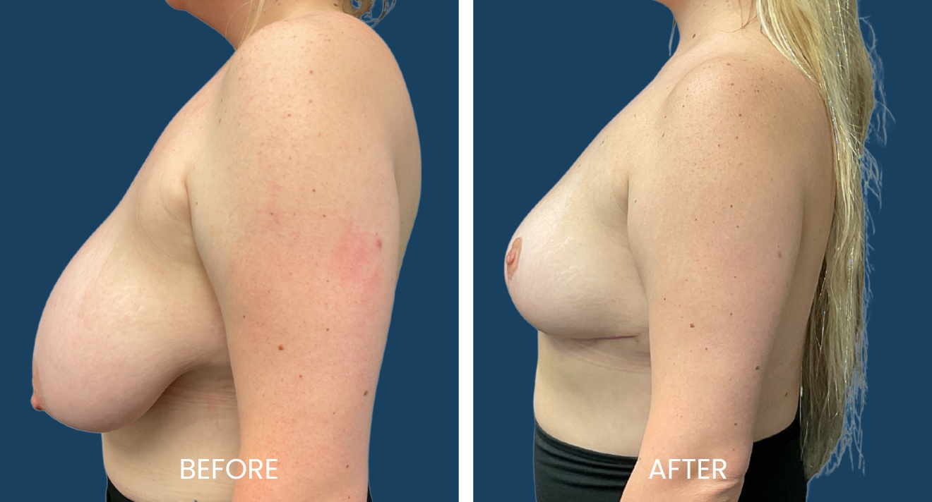Before and after images of a breast augmentation procedure, showcasing the transformation from a fuller, natural breast shape on the left to a more lifted and contoured appearance on the right. The images highlight the significant difference in breast volume and positioning, emphasizing the aesthetic improvements achieved through the surgery. The background is a solid blue, providing contrast to the subject. These visuals can help individuals considering breast augmentation understand potential outcomes and results.