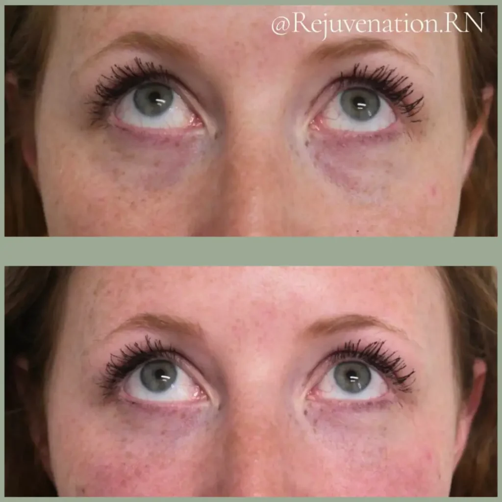 Before and after image showcasing the effects of a cosmetic treatment on under-eye appearance. The top image displays dark circles and less defined eyelashes, while the bottom image highlights improved brightness and enhanced lash definition. The subject has green eyes and light freckles, with a natural makeup look. This visual comparison emphasizes the benefits of the treatment in rejuvenating the eye area, making it suitable for individuals seeking to enhance their appearance. Ideal for beauty and skincare discussions, this image illustrates noticeable results in eye aesthetics.