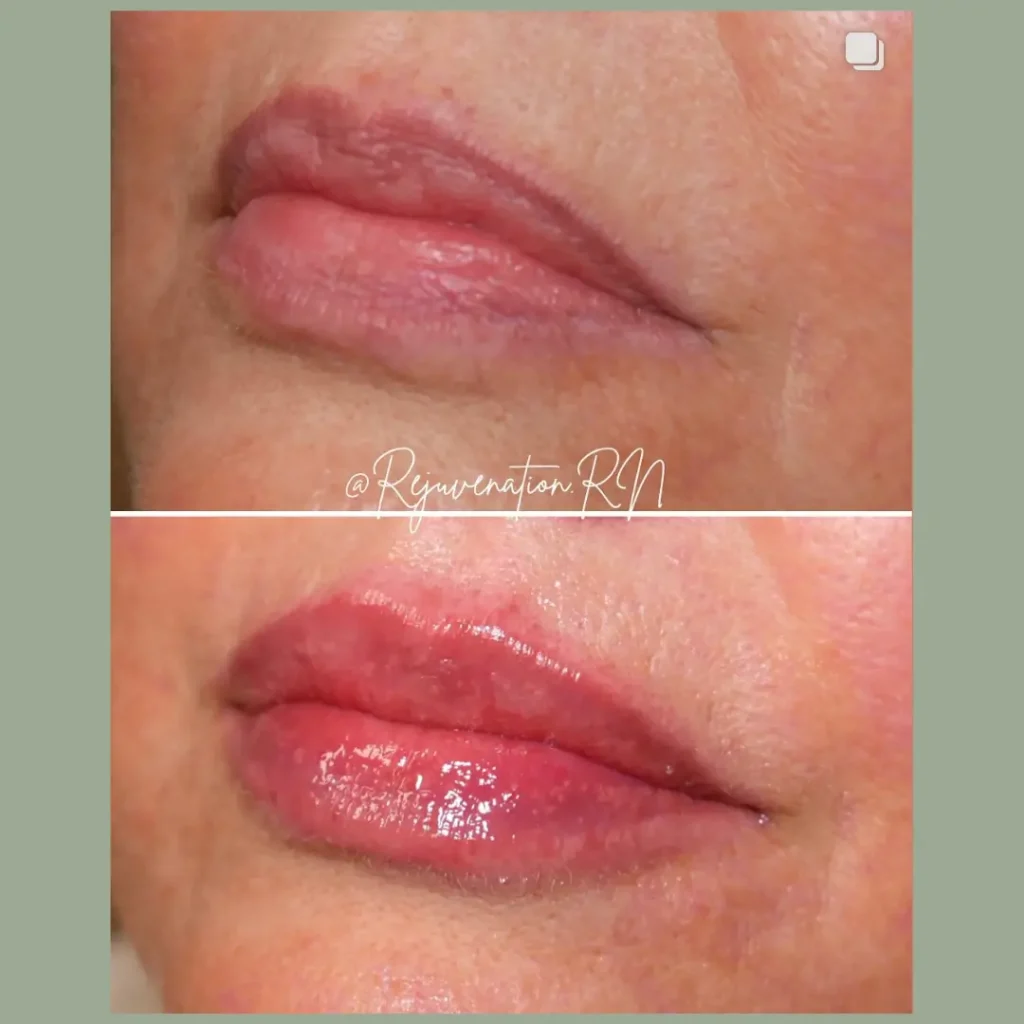 Before and after images of lip enhancement treatment, showcasing the transformation of a person's lips. The top image displays the lips with a natural, subtle appearance, while the bottom image highlights fuller, more defined lips with a glossy finish. This visual comparison emphasizes the effectiveness of the lip enhancement procedure, illustrating improved volume and smoothness. Ideal for those considering cosmetic lip treatments, this image serves as a visual reference for potential results.