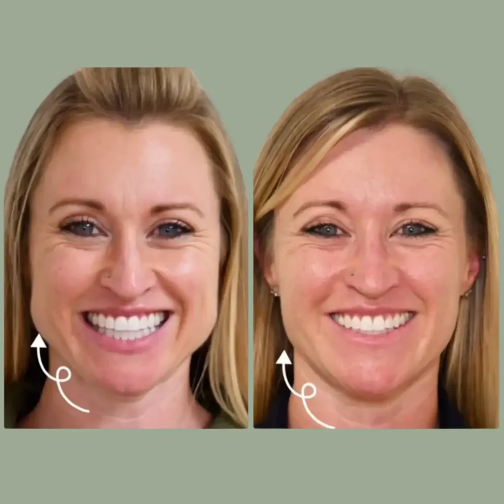 Before and after image showcasing a woman's smile transformation. The left side displays a bright, confident smile with visible facial wrinkles, while the right side presents a smoother, more youthful appearance with a similar smile. The background is a soft green, enhancing the focus on the woman's facial features. Arrows indicate the areas of transformation. This image highlights the effectiveness of cosmetic treatments or skincare routines aimed at improving facial aesthetics. Ideal for content related to beauty, skincare, or dental health.