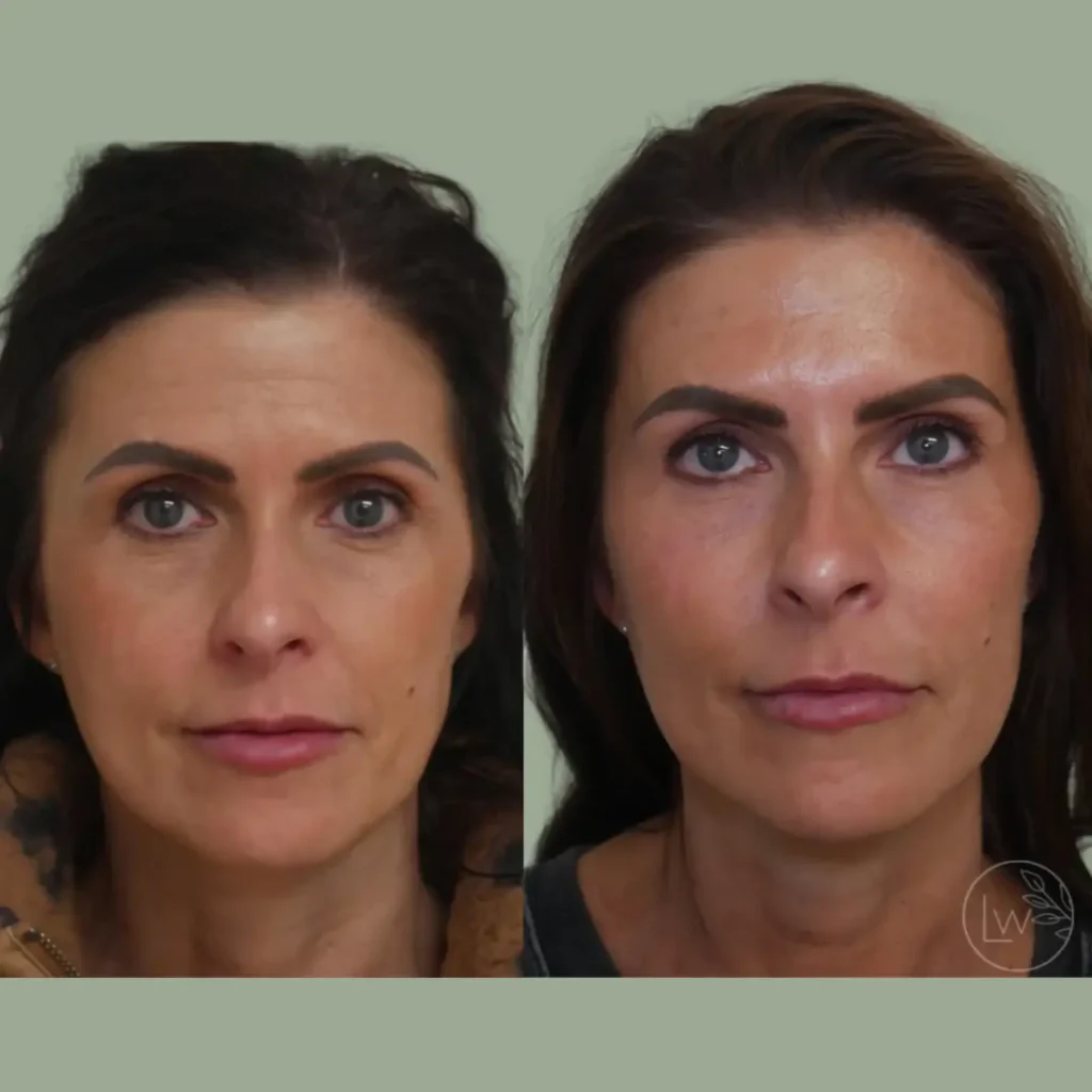Before-and-after image showcasing a woman's facial transformation. The left side displays her appearance prior to a cosmetic procedure, featuring natural makeup and a relaxed expression. The right side reveals her post-procedure look, highlighting enhanced features such as a smoother complexion, defined eyebrows, and a polished makeup application. The background is a soft green, emphasizing the subject's features. This comparison illustrates the effects of cosmetic enhancement, appealing to individuals interested in beauty transformations and skincare solutions.