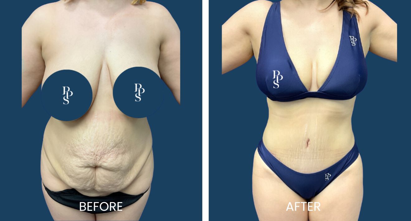 Abdomen PAL liposuction before and after result