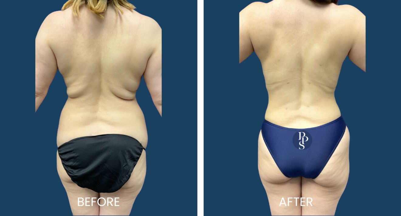 Flanks PAL liposuction before and after result