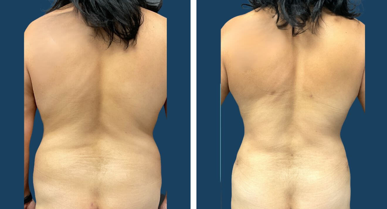 Thighs PAL liposuction before and after result