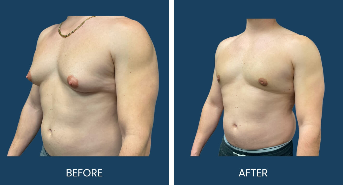 Gynecomastia Patient - 13 B