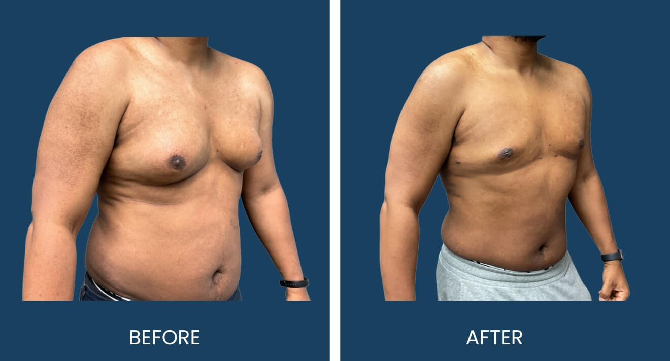 Gynecomastia Patient - 14 B