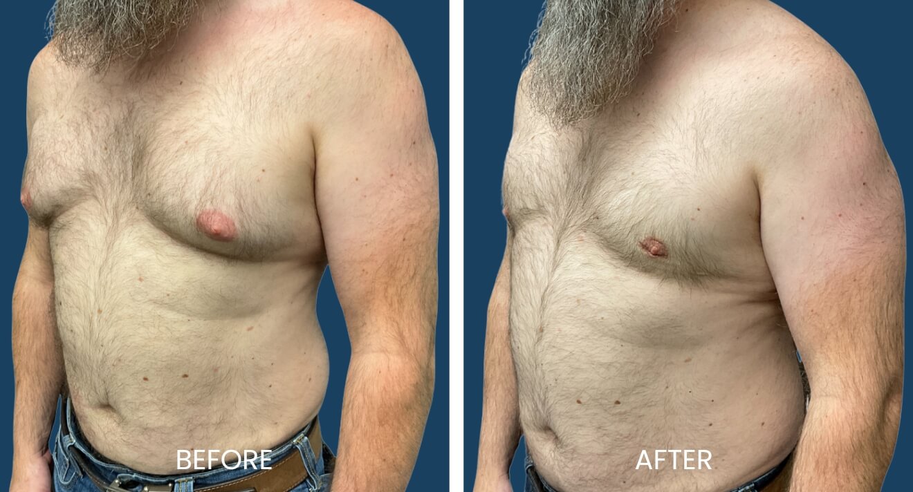 Gynecomastia Patient - 15 B