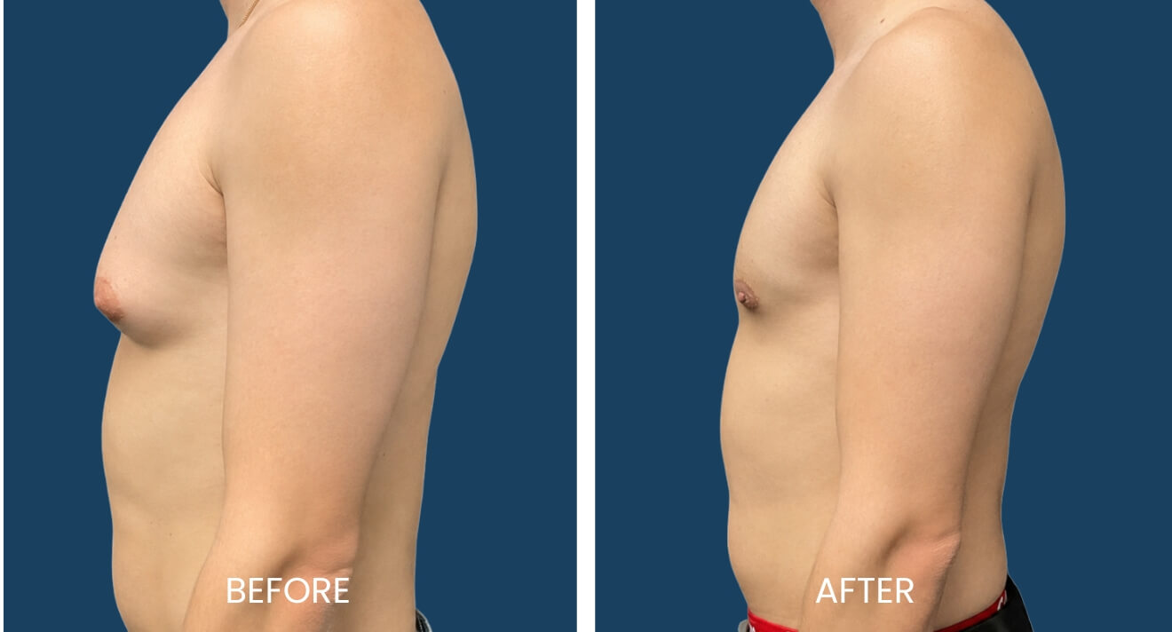 Gynecomastia Patient - 16 B