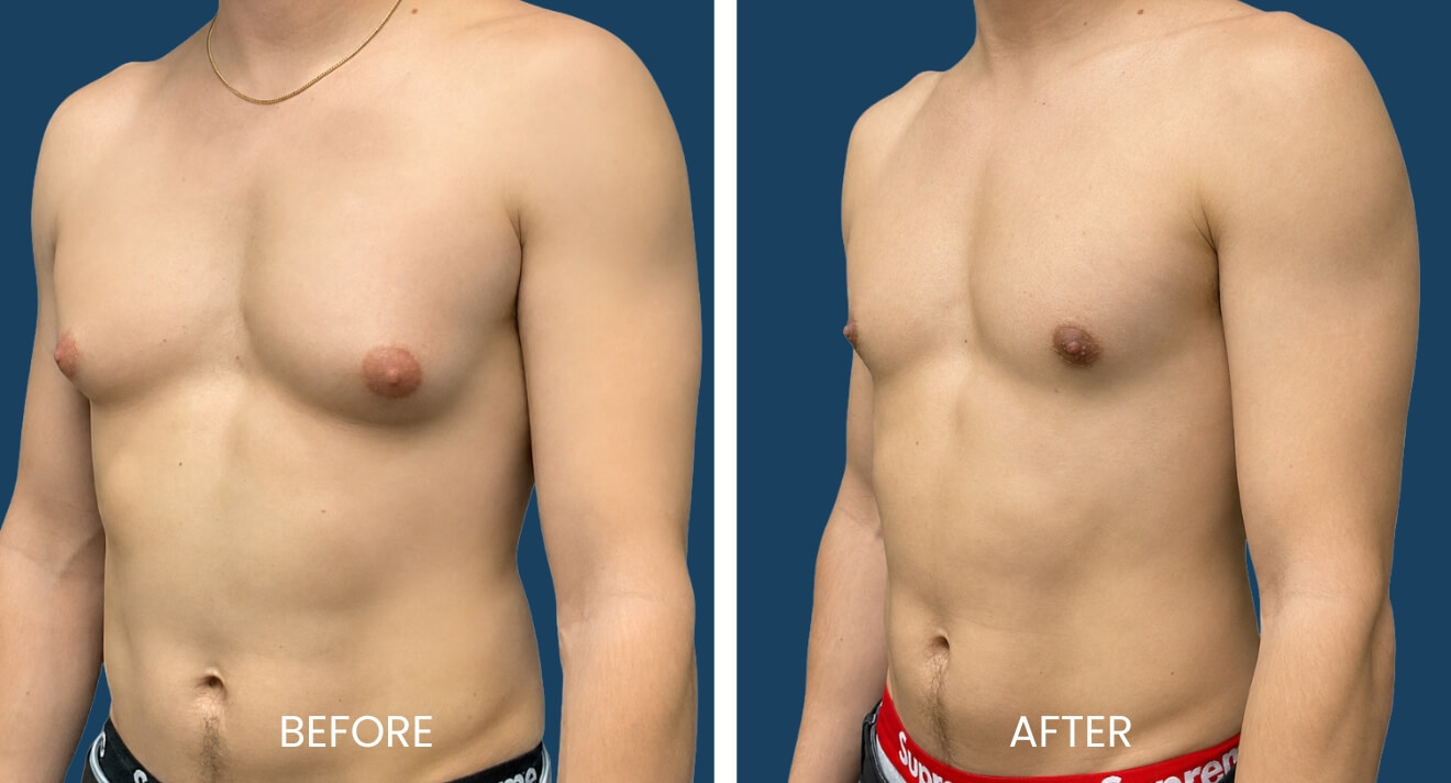 Gynecomastia Patient - 16 C