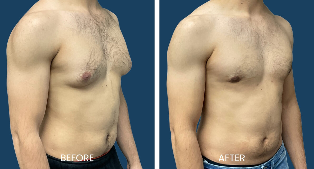 Gynecomastia Patient - 17 B