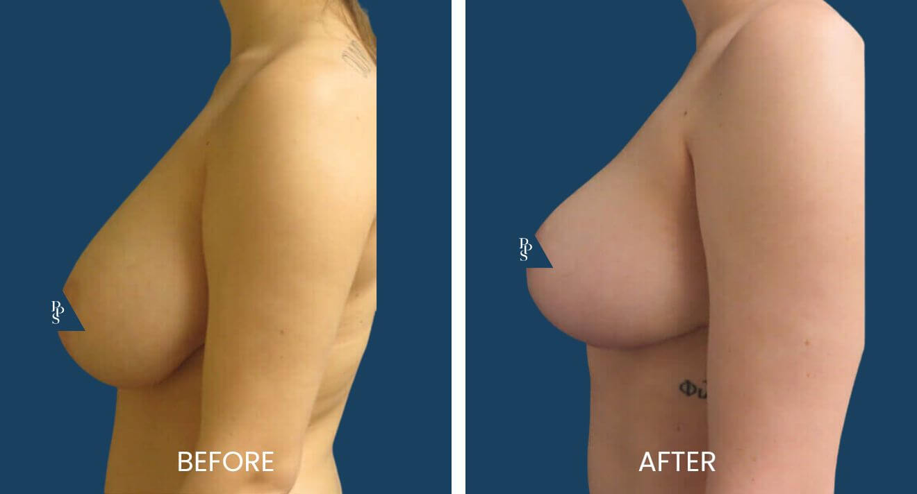 Breast-Lift-11-2.jpg