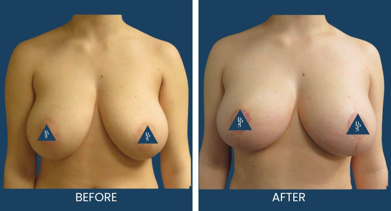 Breast-Lift-11-3.jpg