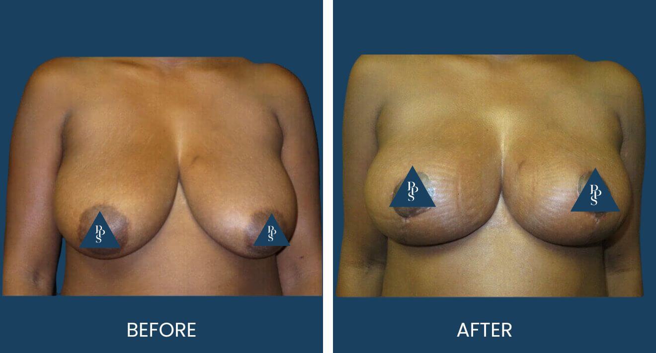 Breast-Lift-11-9.jpg