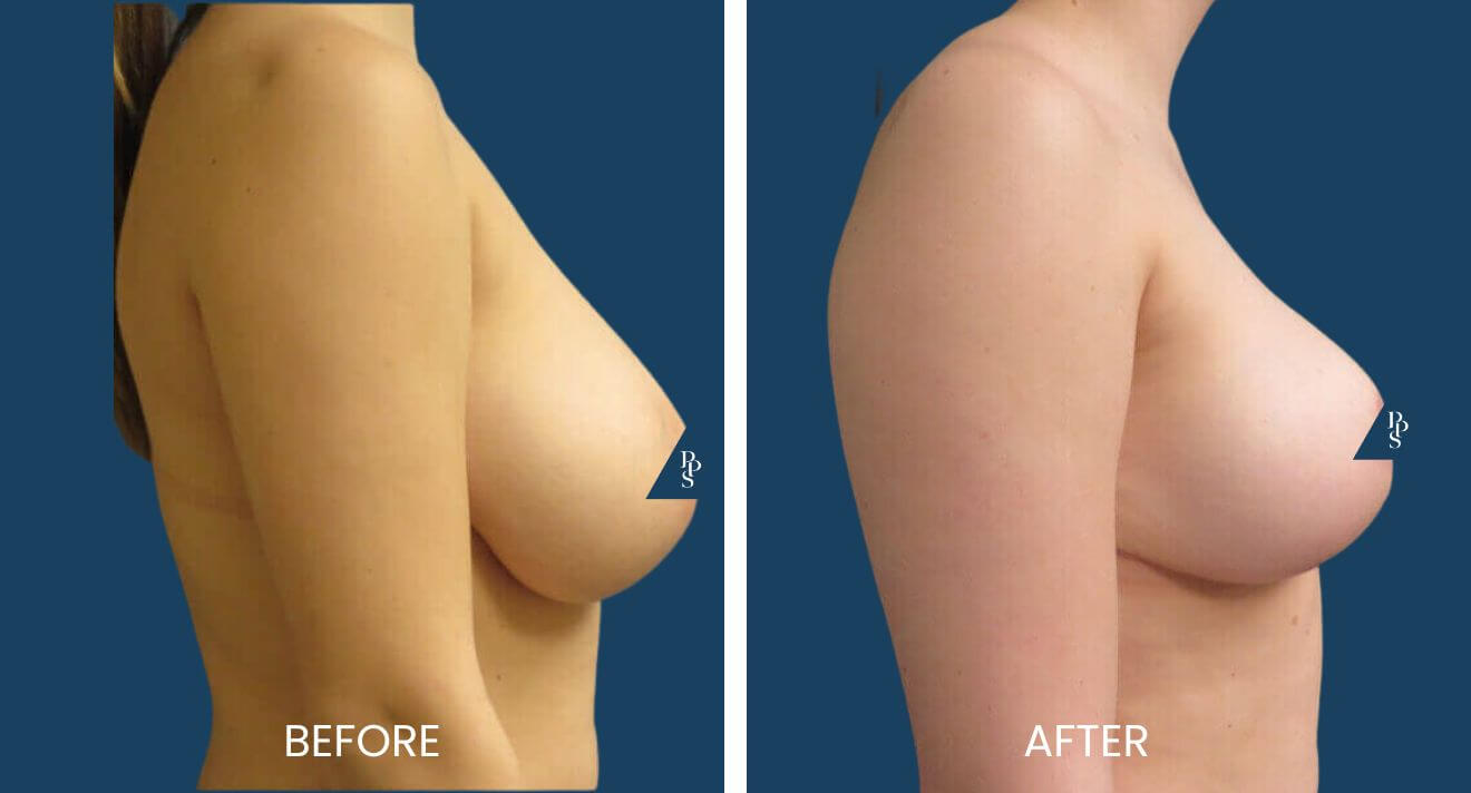Breast-Lift-11.jpg