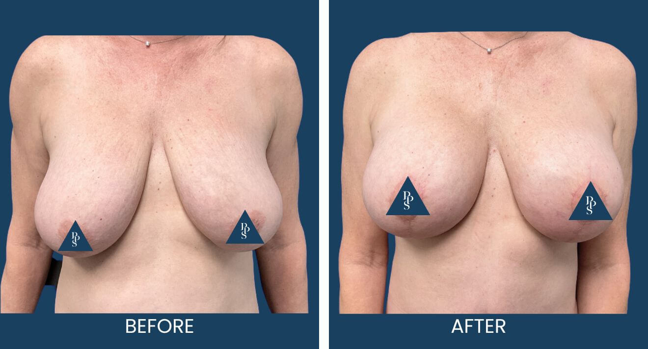 Breast-Lift-3.jpg