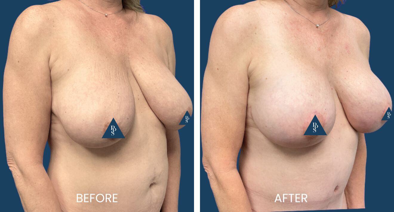 Breast-Lift-4.jpg