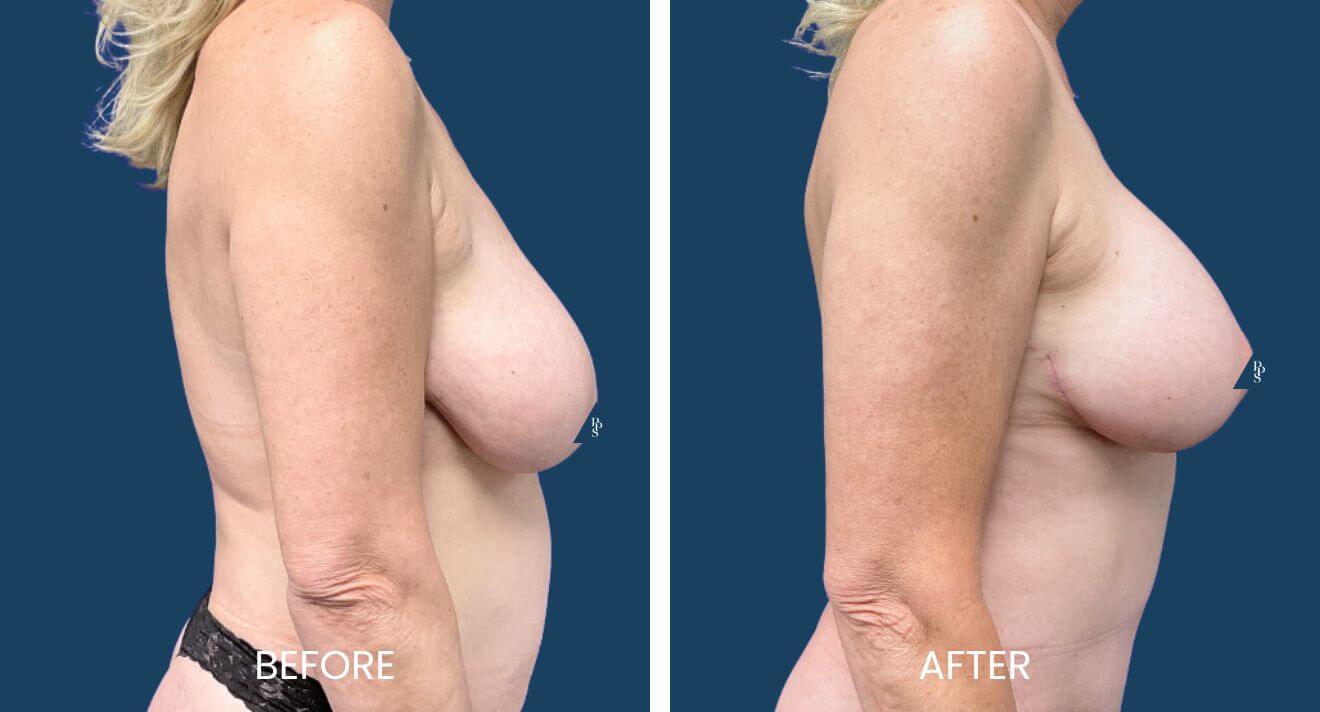 Breast-Lift-5.jpg